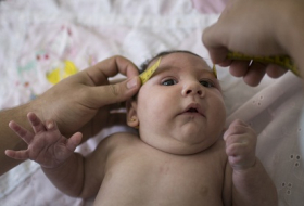 Brazil finds Zika virus in brains of babies born with microcephaly